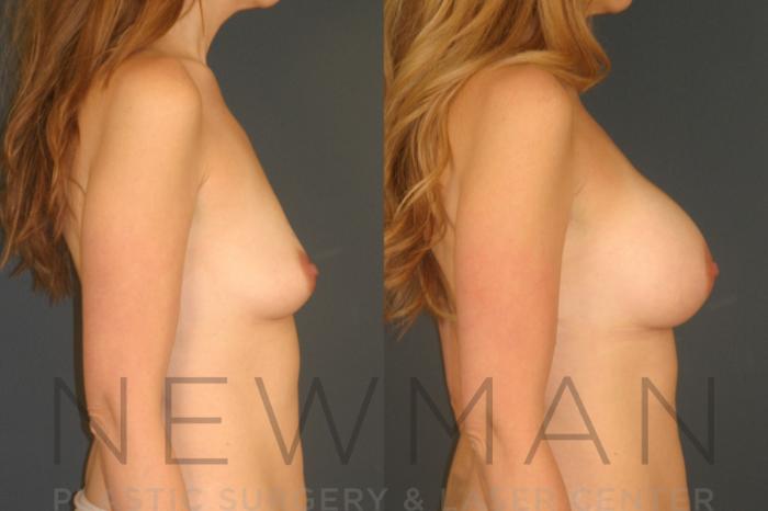 Before & After Breast Augmentation Case 21 Right Side View in Westchester County & Long Island, NY