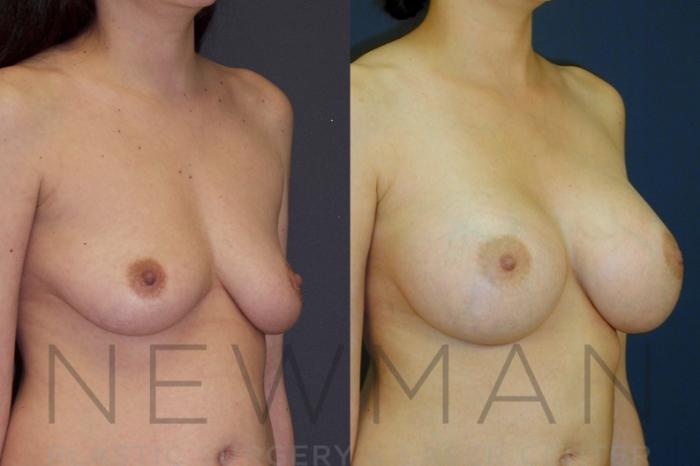 Before & After Breast Augmentation Case 22 Right Oblique View in Westchester County & Long Island, NY