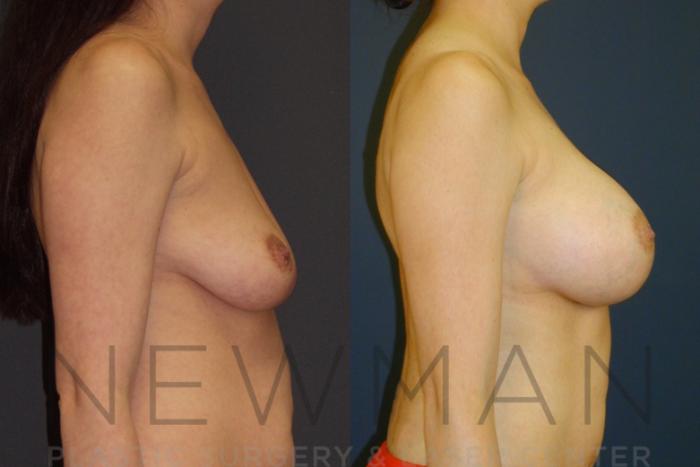 Before & After Breast Augmentation Case 22 Right Side View in Westchester County & Long Island, NY