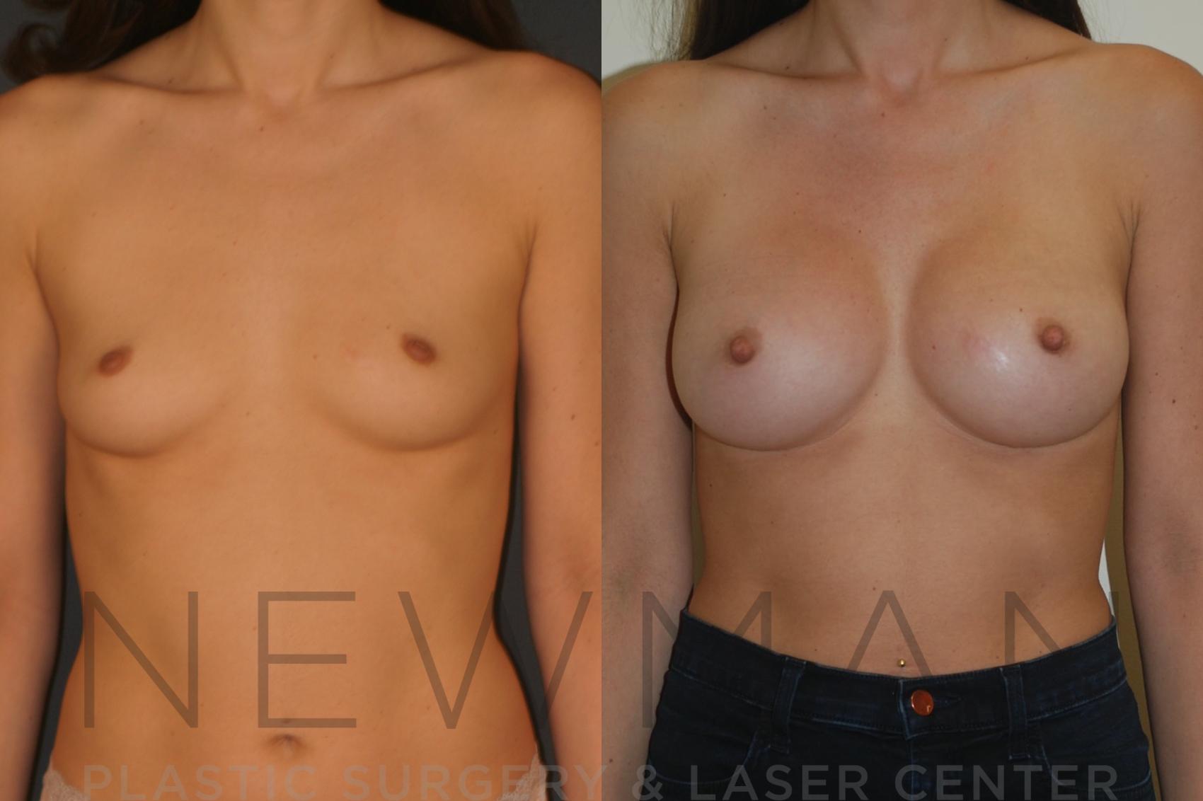 Before & After Breast Augmentation Case 23 Front View in Yonkers, NY