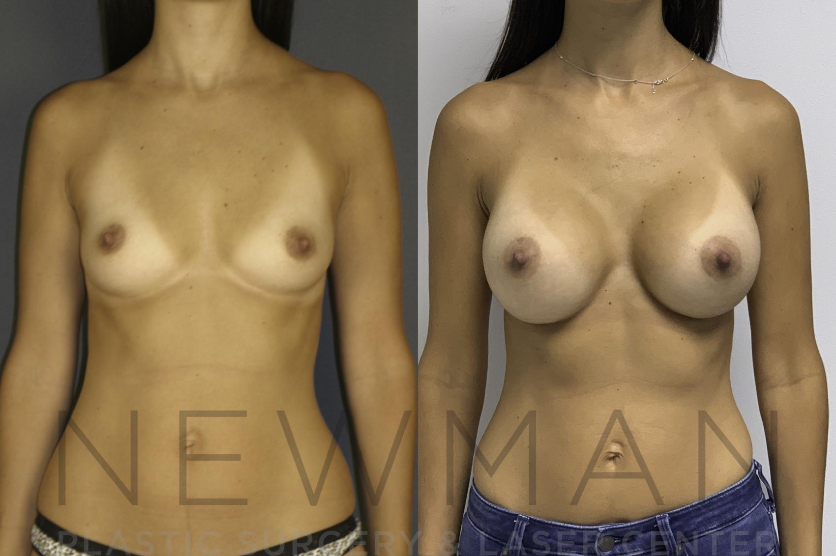 Before & After Breast Augmentation Case 24 Front View in Yonkers, NY