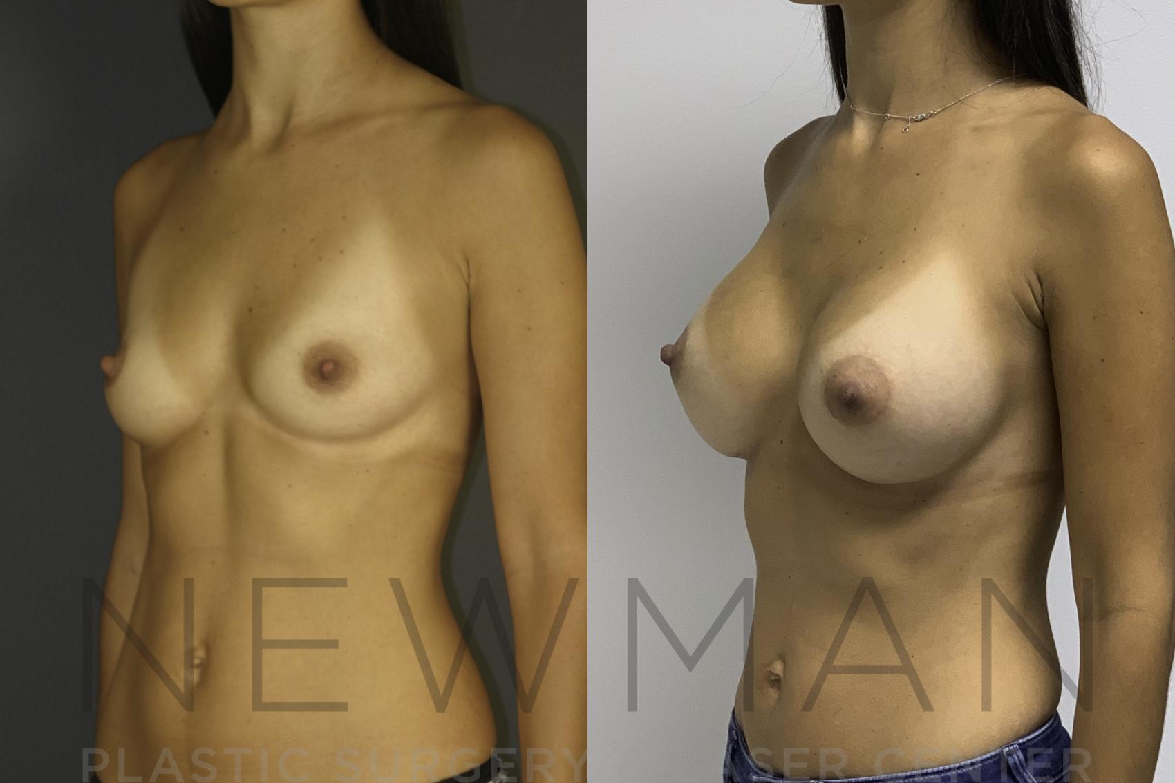 Before & After Breast Augmentation Case 24 Left Oblique View in Westchester County & Long Island, NY