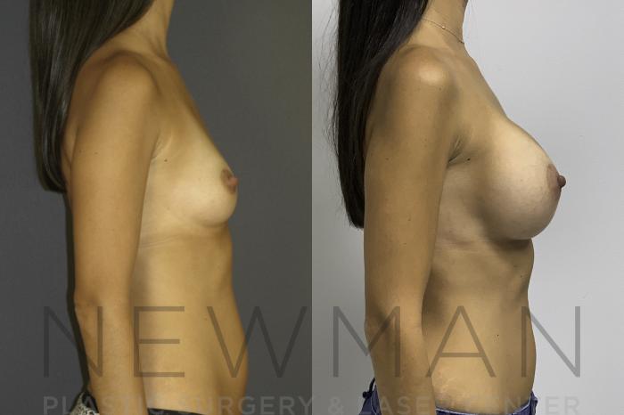 Before & After Breast Augmentation Case 24 Right Side View in Westchester County & Long Island, NY