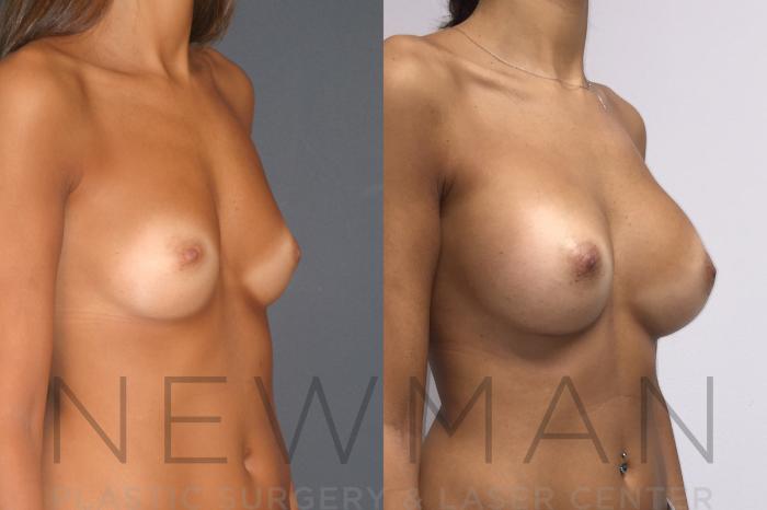 Before & After Breast Augmentation Case 25 Right Oblique View in Westchester County & Long Island, NY