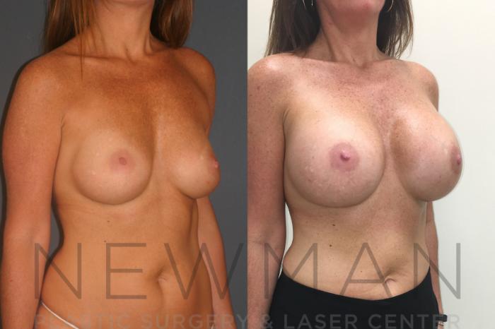 Before & After Breast Augmentation Case 26 Right Oblique View in Westchester County & Long Island, NY