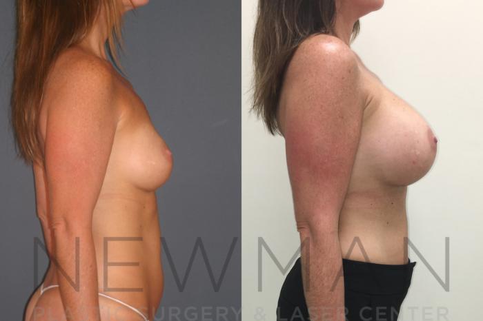 Before & After Breast Augmentation Case 26 Right Side View in Westchester County & Long Island, NY