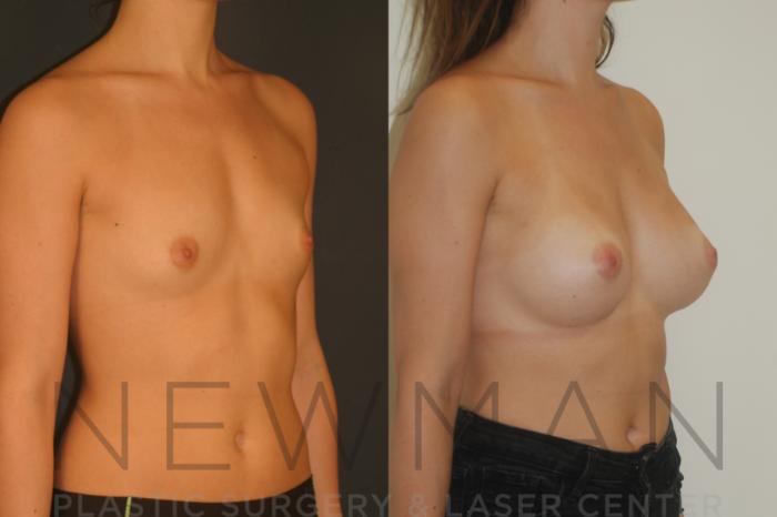 Before & After Breast Augmentation Case 7 Left Oblique View in Westchester County & Long Island, NY