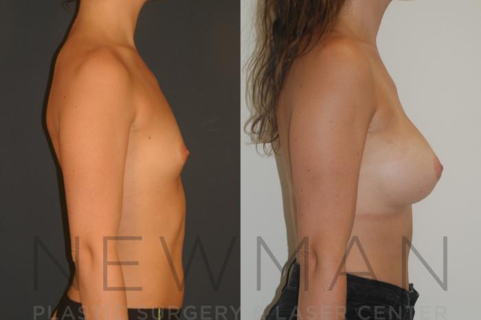 Before & After Breast Augmentation Case 7 Right Side View in Westchester County & Long Island, NY