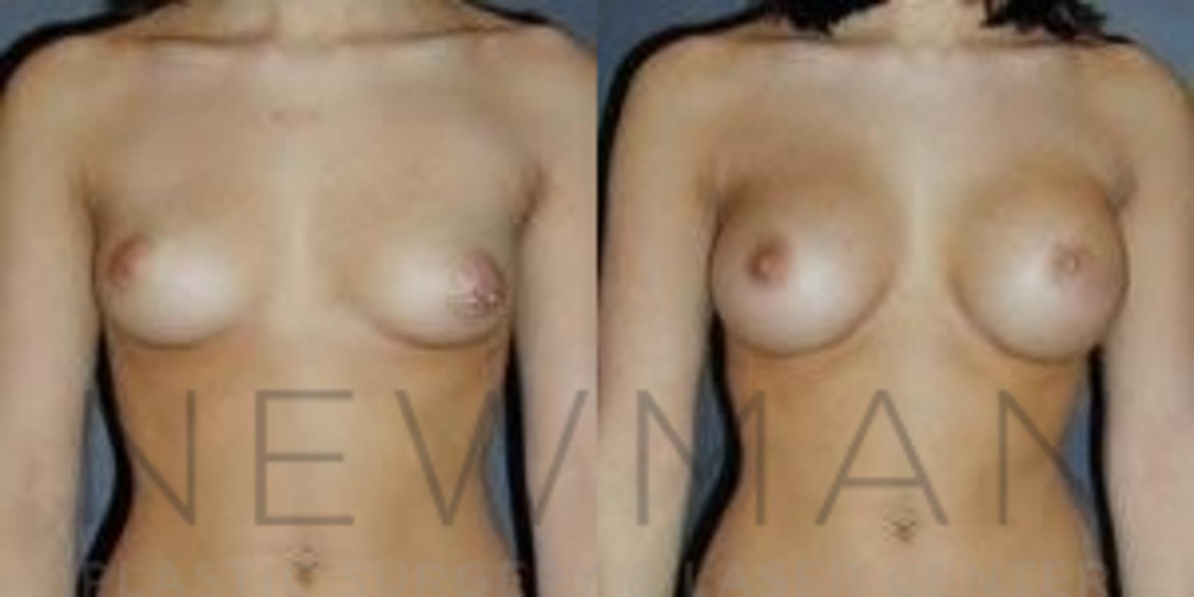 Before & After Breast Augmentation Case 79 Front View in Westchester County & Long Island, NY