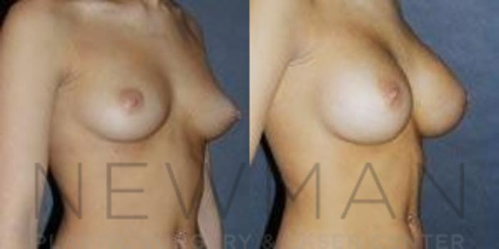 Before & After Breast Augmentation Case 79 Right Oblique View in Westchester County & Long Island, NY