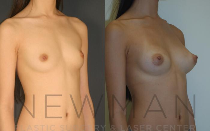 Before & After Breast Augmentation Case 8 Right Oblique View in Westchester County & Long Island, NY