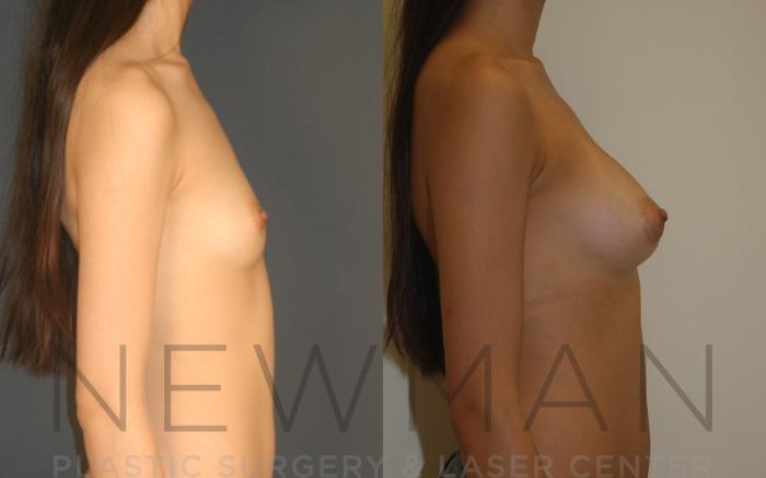 Before & After Breast Augmentation Case 8 Right Side View in Westchester County & Long Island, NY
