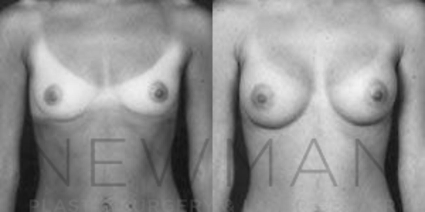 Before & After Breast Augmentation Case 80 Front View in Westchester County & Long Island, NY
