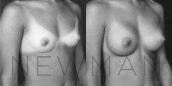 Before & After Breast Augmentation Case 80 Right Oblique View in Westchester County & Long Island, NY