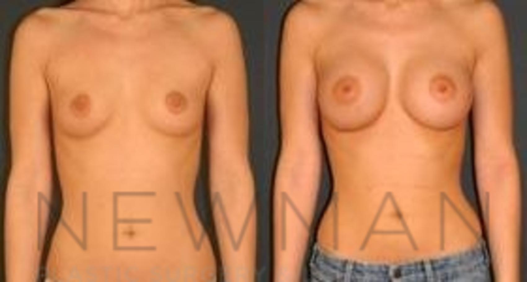 Before & After Breast Augmentation Case 81 Front View in Westchester County & Long Island, NY