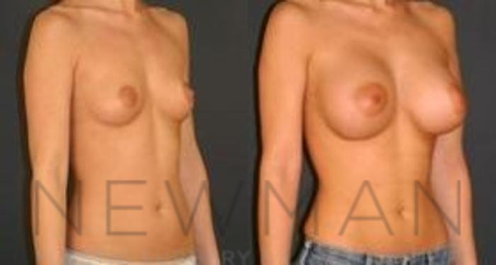 Before & After Breast Augmentation Case 81 Right Oblique View in Westchester County & Long Island, NY
