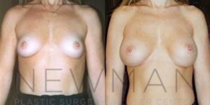 Before & After Breast Augmentation Case 82 Front View in Westchester County & Long Island, NY