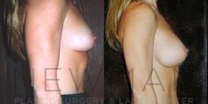 Before & After Breast Augmentation Case 82 Right Side View in Westchester County & Long Island, NY