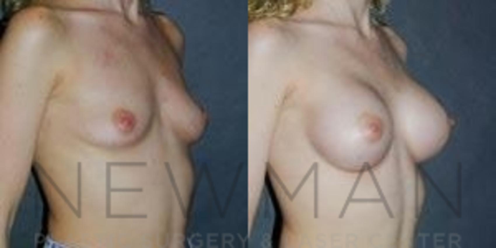 Before & After Breast Augmentation Case 83 Right Oblique View in Yonkers, NY