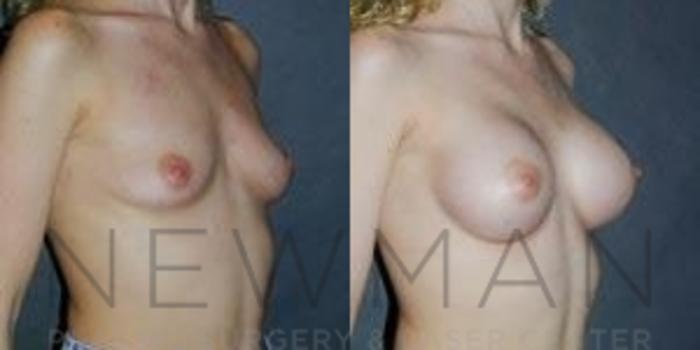 Before & After Breast Augmentation Case 83 Right Oblique View in Westchester County & Long Island, NY