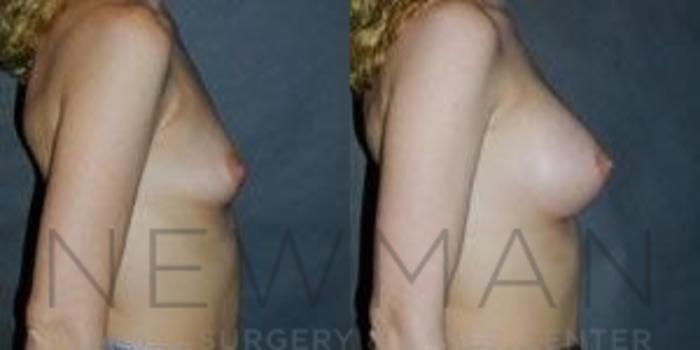 Before & After Breast Augmentation Case 83 Right Side View in Westchester County & Long Island, NY