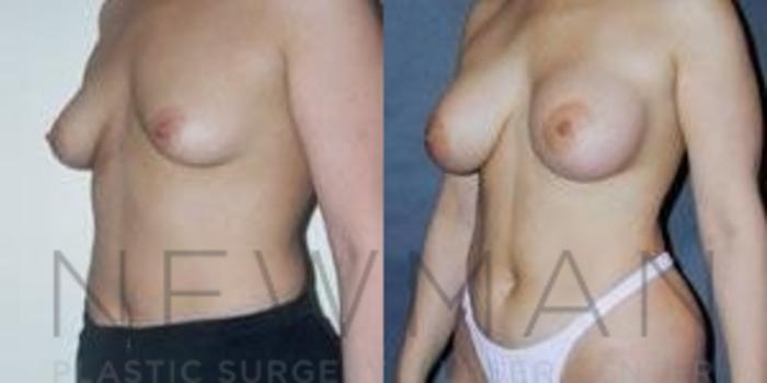 Before & After Breast Augmentation Case 84 Left Oblique View in Westchester County & Long Island, NY
