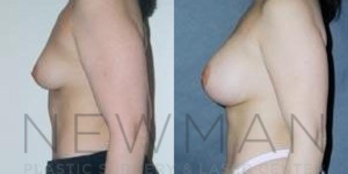Before & After Breast Augmentation Case 84 Left Side View in Westchester County & Long Island, NY