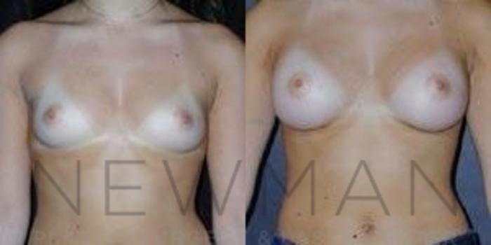 Before & After Breast Augmentation Case 85 Front View in Westchester County & Long Island, NY