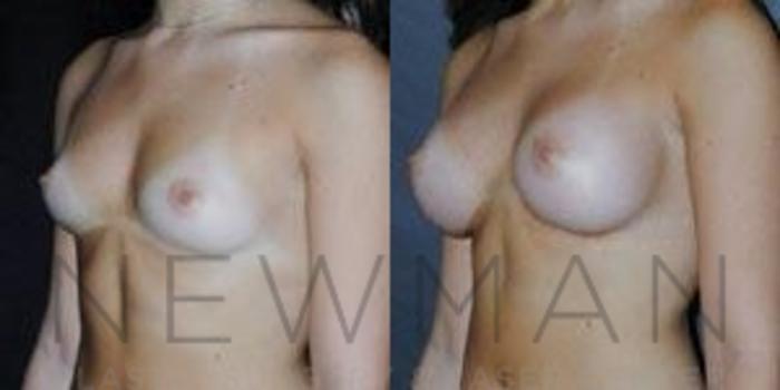 Before & After Breast Augmentation Case 85 Left Oblique View in Westchester County & Long Island, NY