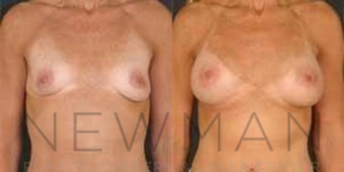 Before & After Breast Augmentation Case 87 Front View in Westchester County & Long Island, NY