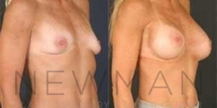 Before & After Breast Augmentation Case 87 Right Oblique View in Westchester County & Long Island, NY