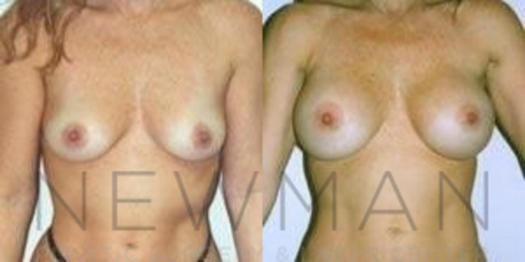 Before & After Breast Augmentation Case 88 Front View in Westchester County & Long Island, NY