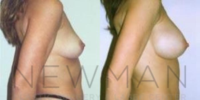 Before & After Breast Augmentation Case 88 Right Side View in Westchester County & Long Island, NY