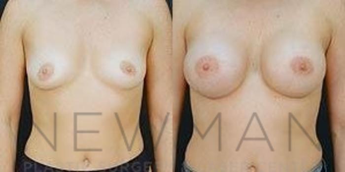 Before & After Breast Augmentation Case 89 Front View in Westchester County & Long Island, NY