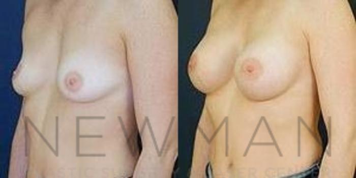 Before & After Breast Augmentation Case 89 Left Oblique View in Westchester County & Long Island, NY