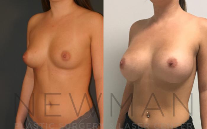 Before & After Breast Augmentation Case 9 Left Oblique View in Westchester County & Long Island, NY