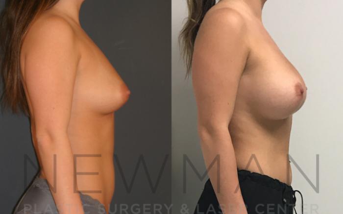 Before & After Breast Augmentation Case 9 Right Side View in Westchester County & Long Island, NY