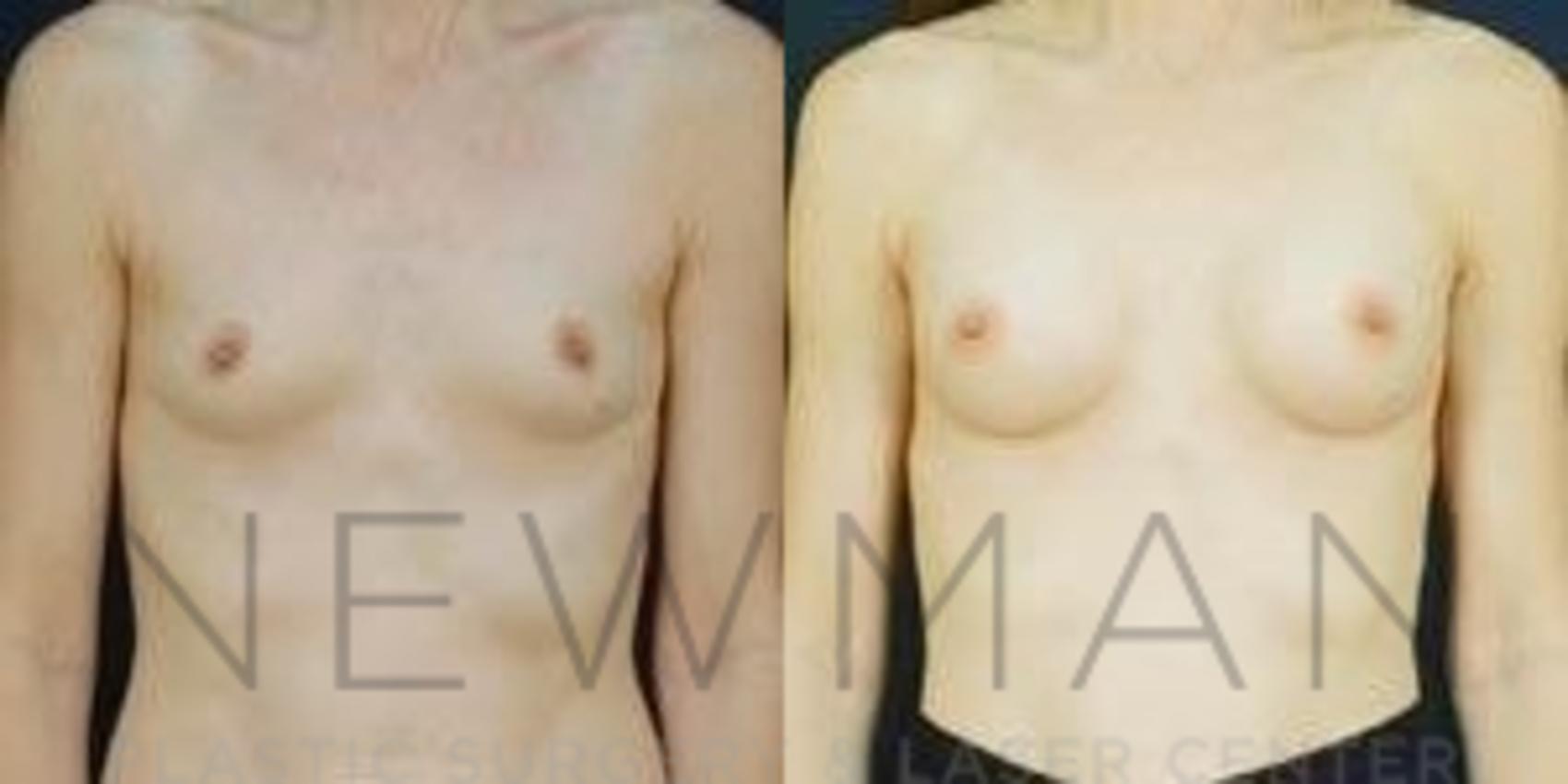 Before & After Breast Augmentation Case 90 Front View in Westchester County & Long Island, NY
