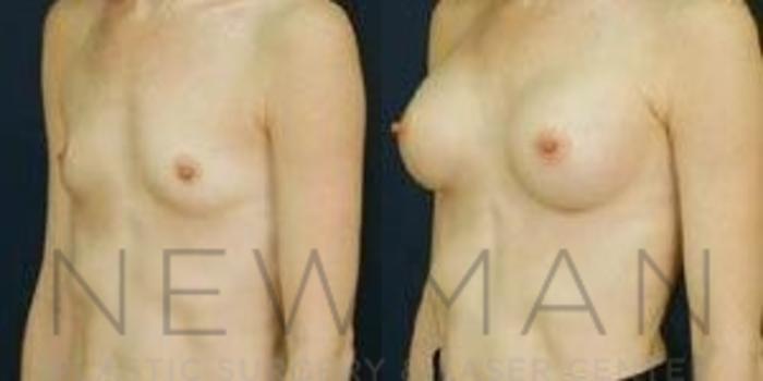 Before & After Breast Augmentation Case 90 Left Oblique View in Westchester County & Long Island, NY