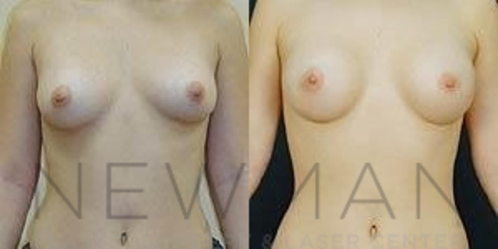Before & After Breast Augmentation Case 91 Front View in Westchester County & Long Island, NY