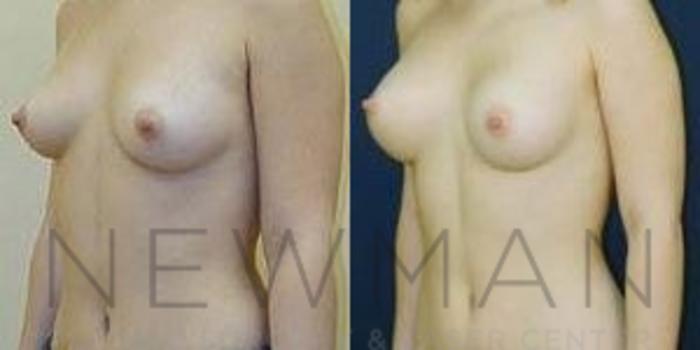 Before & After Breast Augmentation Case 91 Left Oblique View in Westchester County & Long Island, NY