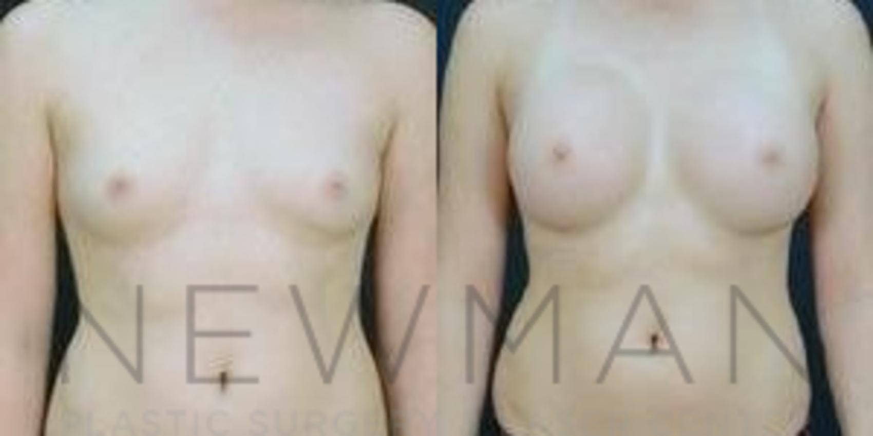 Before & After Breast Augmentation Case 92 Front View in Westchester County & Long Island, NY