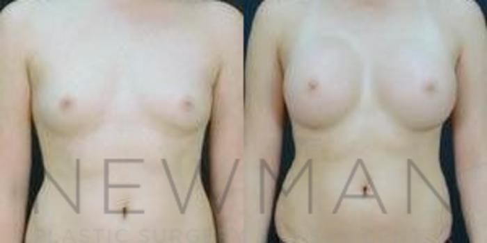 Before & After Breast Augmentation Case 92 Front View in Westchester County & Long Island, NY