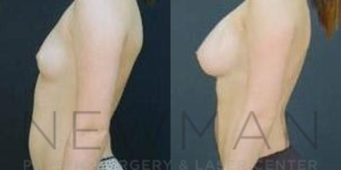 Before & After Breast Augmentation Case 92 Left Side View in Westchester County & Long Island, NY