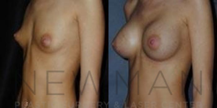 Before & After Breast Augmentation Case 93 Left Oblique View in Westchester County & Long Island, NY