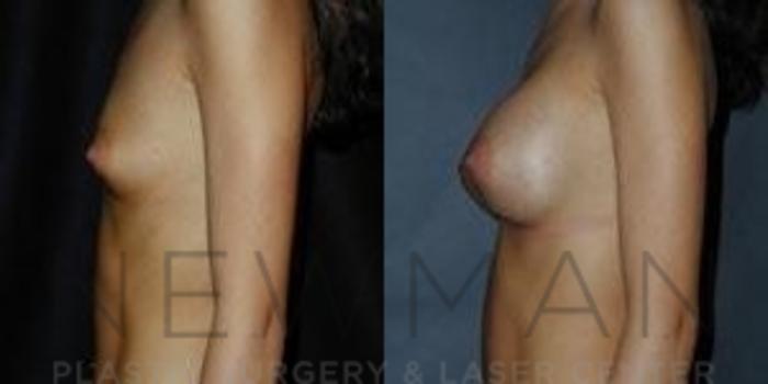 Before & After Breast Augmentation Case 93 Left Side View in Westchester County & Long Island, NY