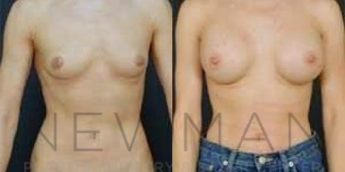 Before & After Breast Augmentation Case 94 Front View in Westchester County & Long Island, NY