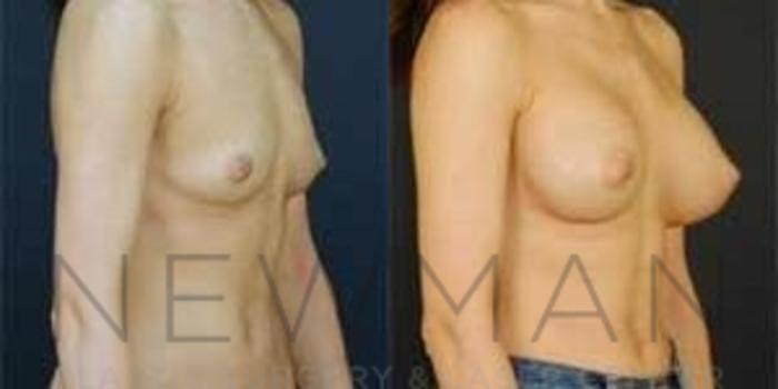 Before & After Breast Augmentation Case 94 Right Oblique View in Westchester County & Long Island, NY