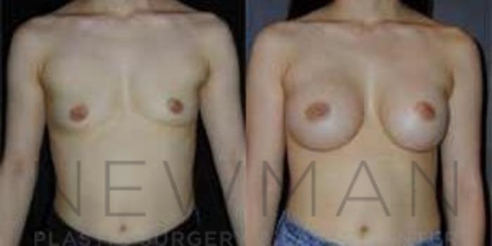 Before & After Breast Augmentation Case 95 Front View in Westchester County & Long Island, NY