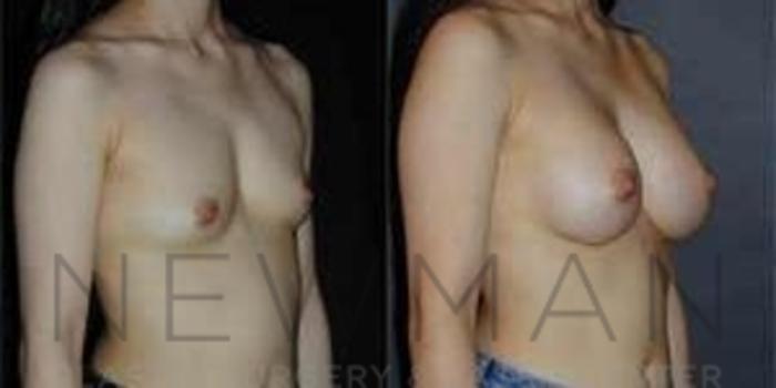 Before & After Breast Augmentation Case 95 Right Oblique View in Westchester County & Long Island, NY